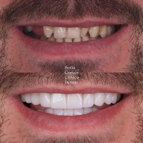 😁 CARILLAS DENTALES | SONRIE CON CONFIANZA Y ESTILO