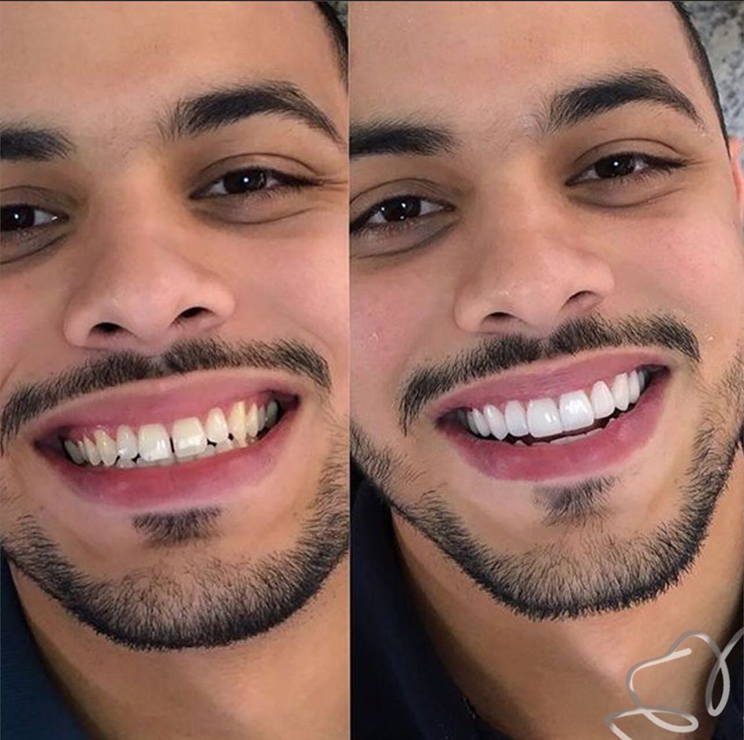 😁 CARILLAS DENTALES |  SONRIE CON CONFIANZA Y ESTILO