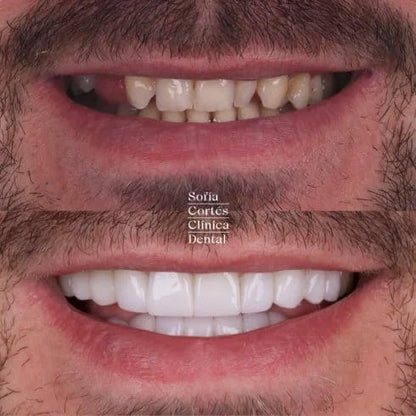 😁 CARILLAS DENTALES |  SONRIE CON CONFIANZA Y ESTILO